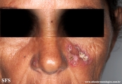 lupus erythematosus chronicus discoides