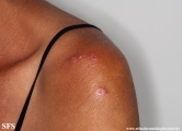 lupus erythematosus chronicus discoides