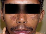 lupus erythematosus chronicus discoides