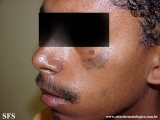 lupus erythematosus chronicus discoides