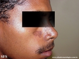 lupus erythematosus chronicus discoides