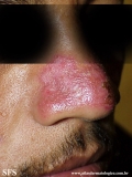 lupus erythematosus chronicus discoides