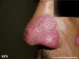 lupus erythematosus chronicus discoides