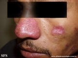 lupus erythematosus chronicus discoides