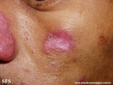 lupus erythematosus chronicus discoides