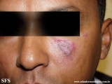 lupus erythematosus chronicus discoides