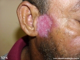lupus erythematosus chronicus discoides