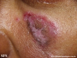 lupus erythematosus chronicus discoides