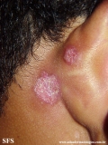 lupus erythematosus chronicus discoides