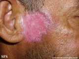 lupus erythematosus chronicus discoides
