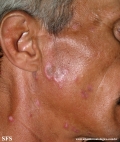 lupus erythematosus chronicus discoides