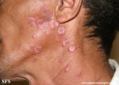 lupus erythematosus chronicus discoides