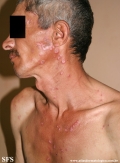 lupus erythematosus chronicus discoides