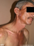 lupus erythematosus chronicus discoides