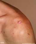 lupus erythematosus chronicus discoides