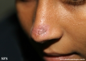 lupus erythematosus chronicus discoides