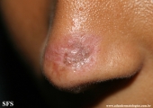 lupus erythematosus chronicus discoides