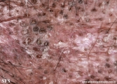 lupus erythematosus chronicus discoides