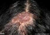 lupus erythematosus chronicus discoides