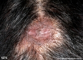 lupus erythematosus chronicus discoides
