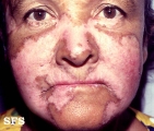 lupus erythematosus chronicus discoides