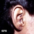 lupus erythematosus chronicus discoides