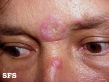 lupus erythematosus chronicus discoides