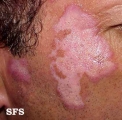 lupus erythematosus chronicus discoides