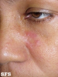 lupus erythematosus chronicus discoides