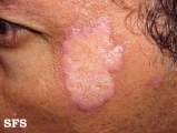 lupus erythematosus chronicus discoides