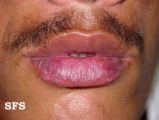 lupus erythematosus chronicus discoides