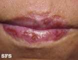 lupus erythematosus chronicus discoides