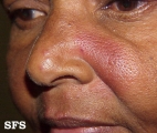 lupus erythematosus chronicus discoides