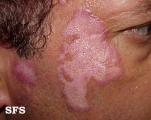 lupus erythematosus chronicus discoides