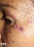 lupus erythematosus chronicus discoides
