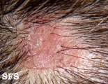 lupus erythematosus chronicus discoides