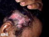 lupus erythematosus chronicus discoides