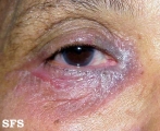 lupus erythematosus chronicus discoides