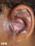 lupus erythematosus chronicus discoides