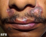 lupus erythematosus chronicus discoides