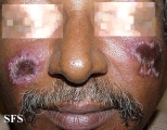 lupus erythematosus chronicus discoides