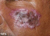 lupus erythematosus chronicus discoides