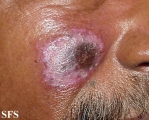 lupus erythematosus chronicus discoides