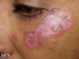 lupus erythematosus chronicus discoides