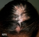 lupus erythematosus chronicus discoides