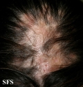 lupus erythematosus chronicus discoides