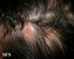 lupus erythematosus chronicus discoides