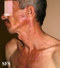 lupus erythematosus chronicus discoides