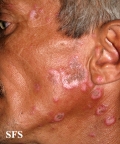lupus erythematosus chronicus discoides