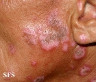 lupus erythematosus chronicus discoides
